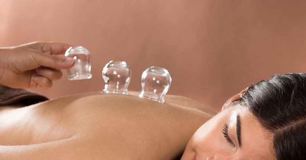 Cupping-for-weight-loss